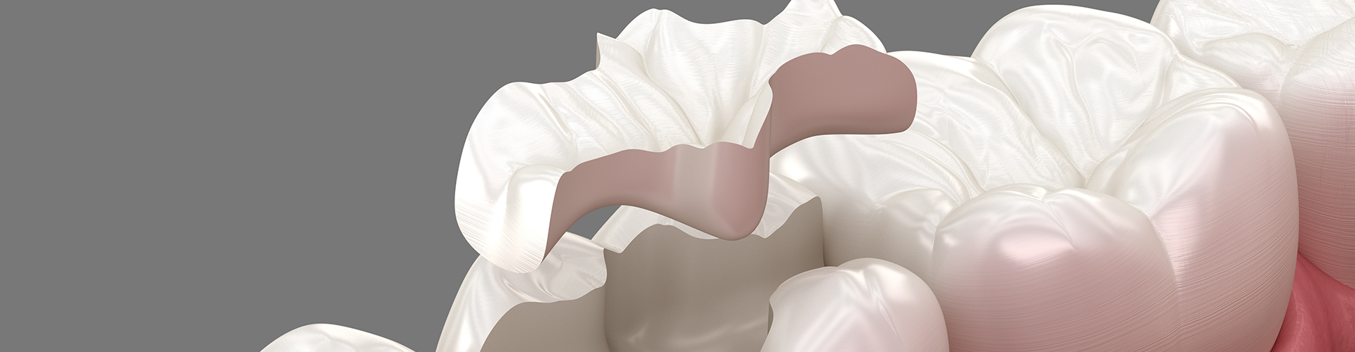 rendering of an inlay being placed in a molar